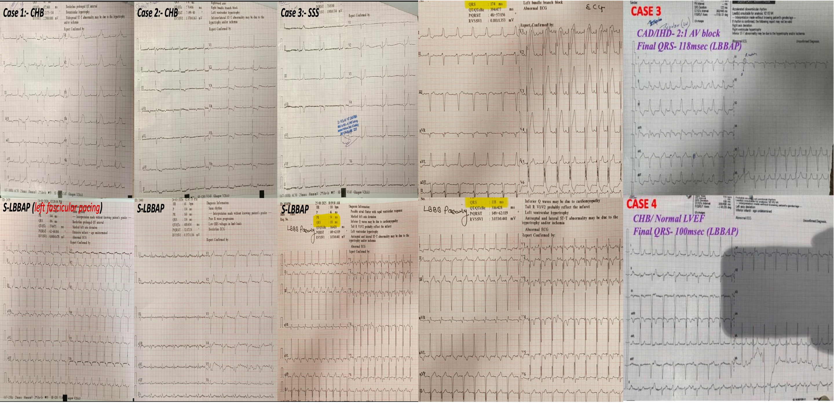 Coronary Angiography